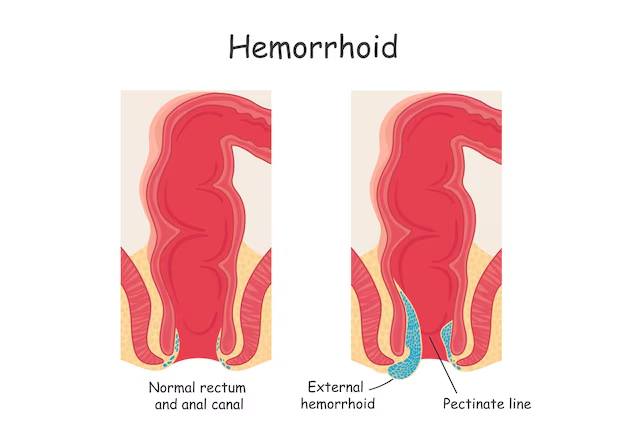 Hemorrhoids