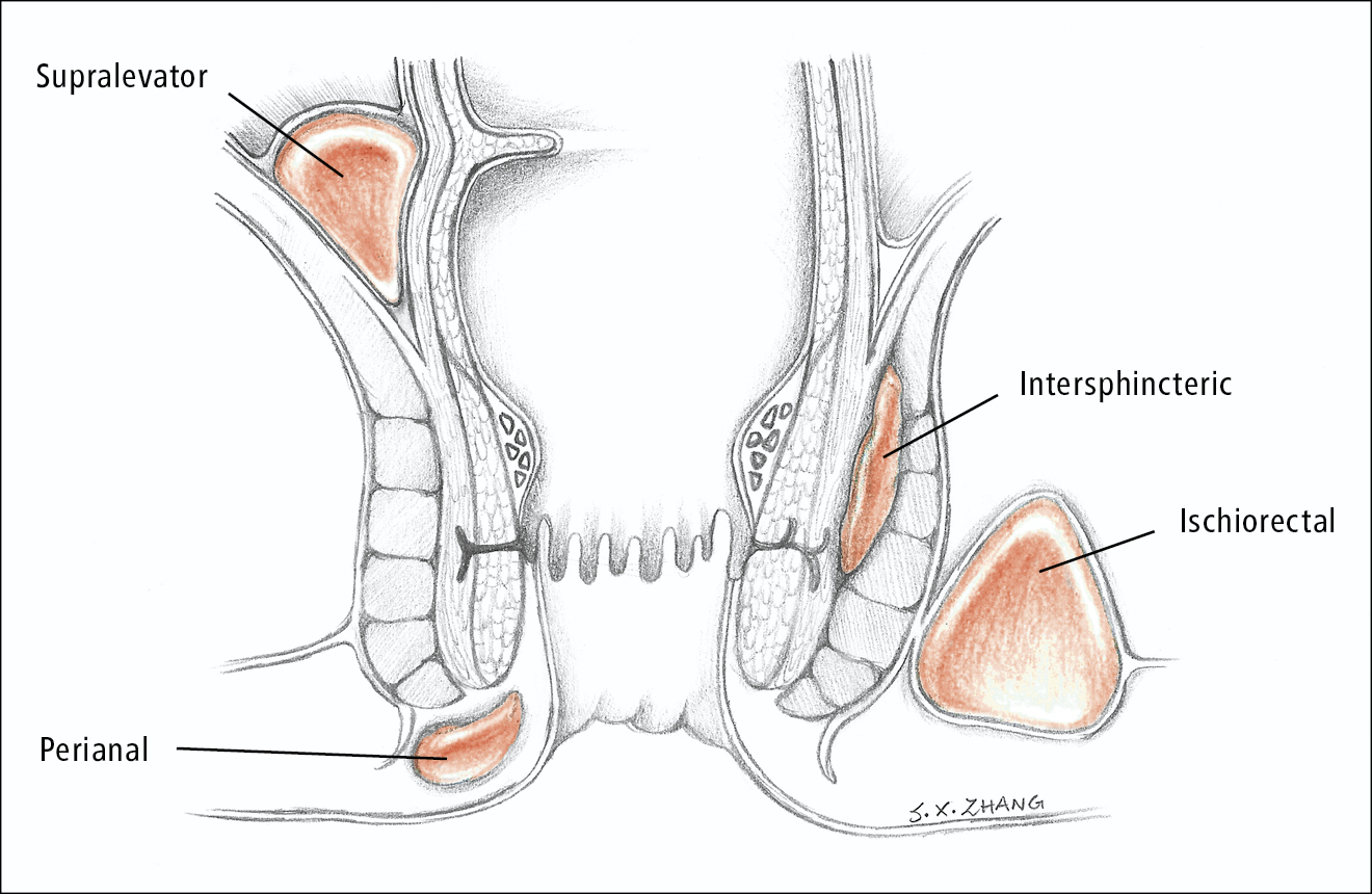 Anorectal Abscess Types